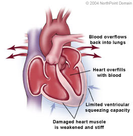 Congestive Heart Failure