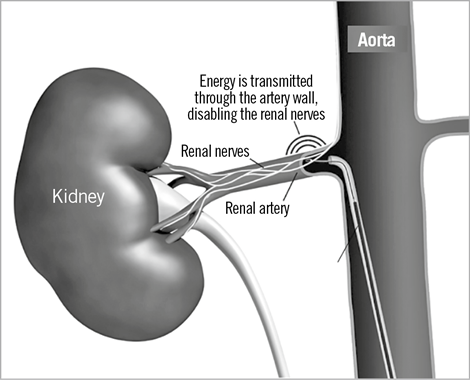 Renal Denervation Renal Denervation